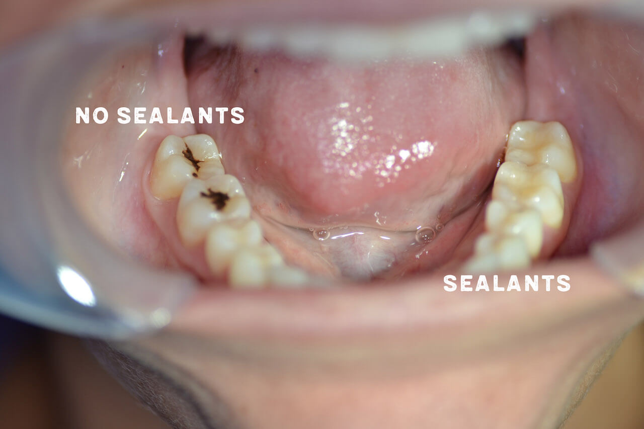 What are dental sealants and why does my child need them?