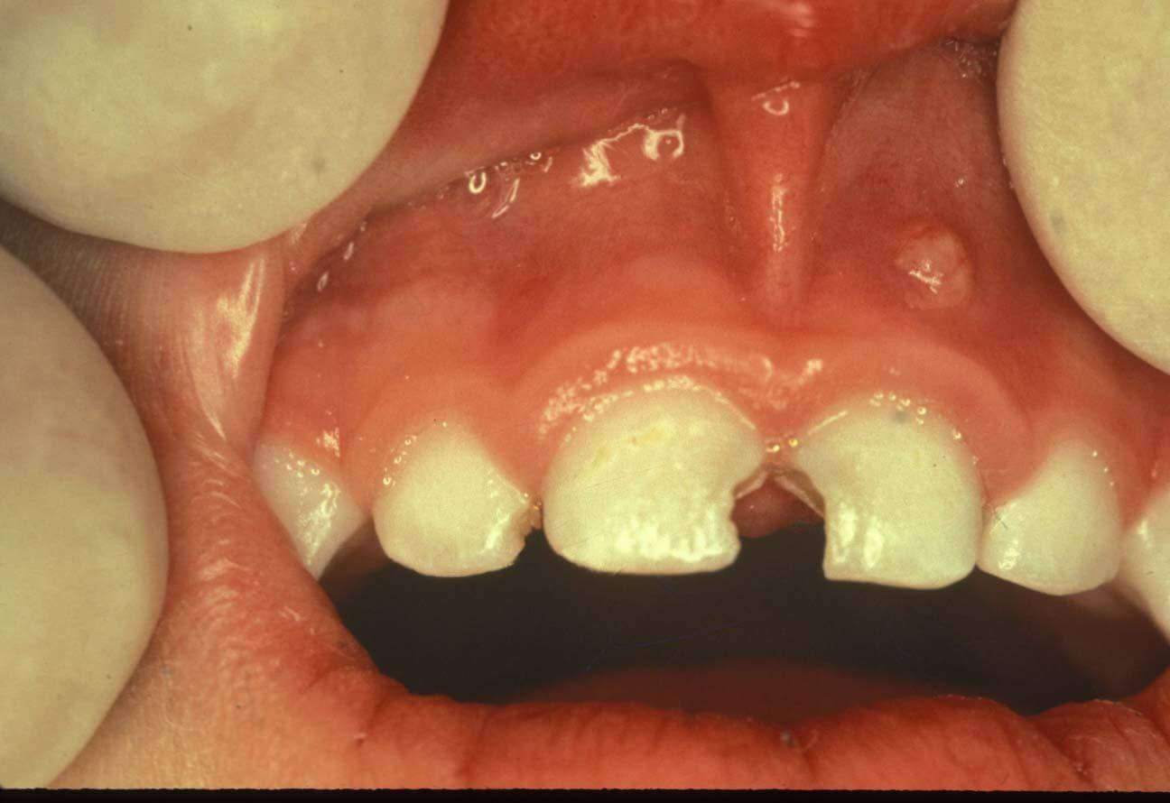 Do baby teeth really matter; don't they just fall out?