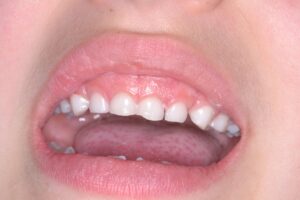 Healthy Baby Teeth