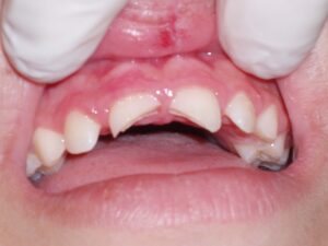 Kids Teeth Fractured Tooth