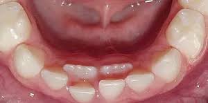 Shark teeth in kids