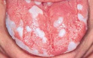 Oral Cancer on tongue