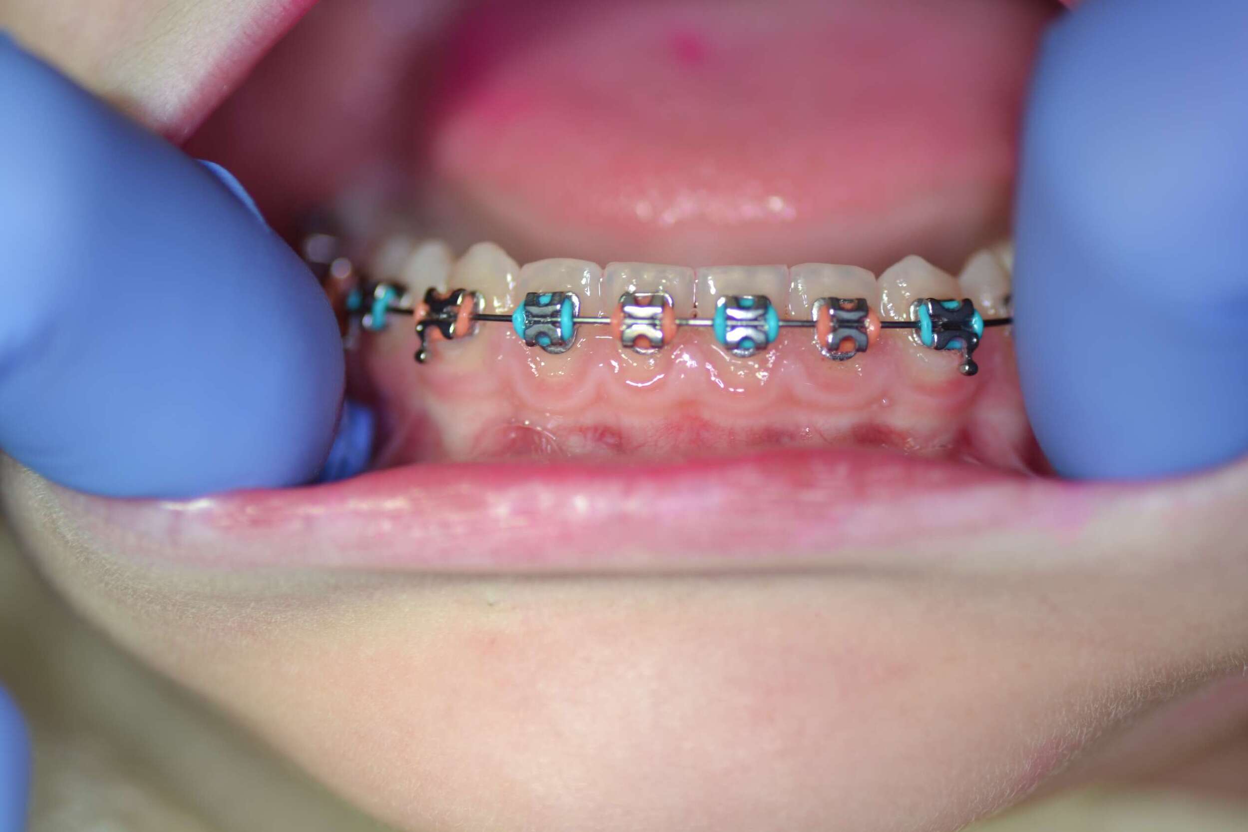 How To Brush with Braces (step-by-step)
